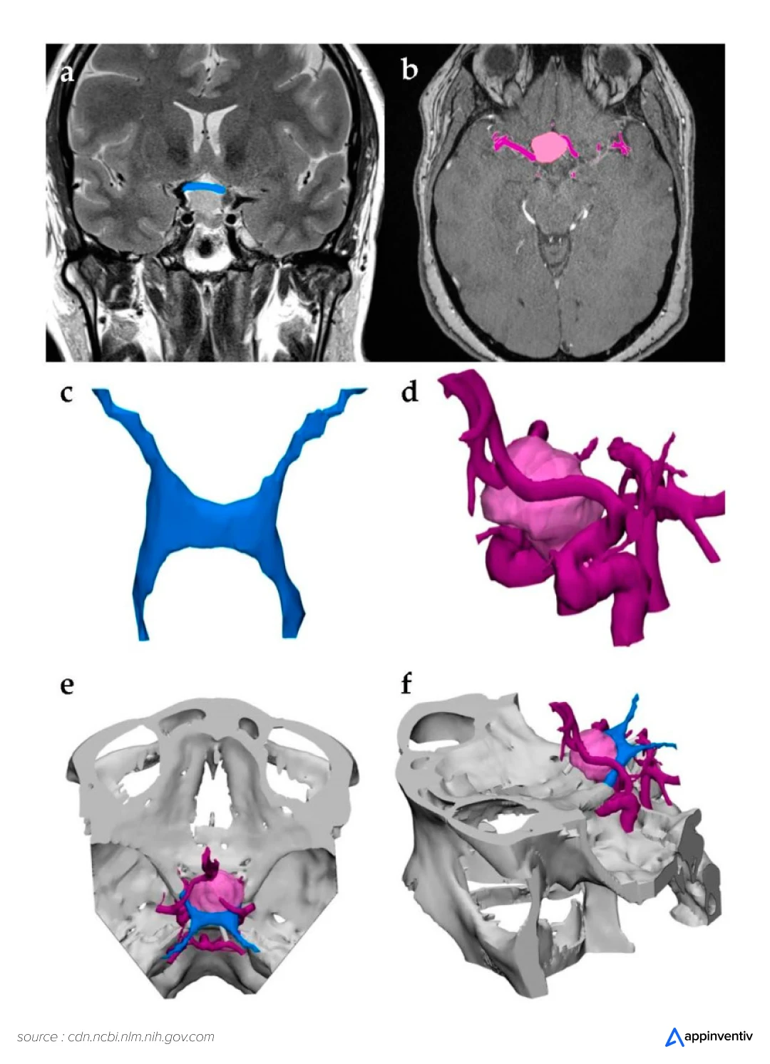3D-Printing Model Image to visualize a brain tumor.